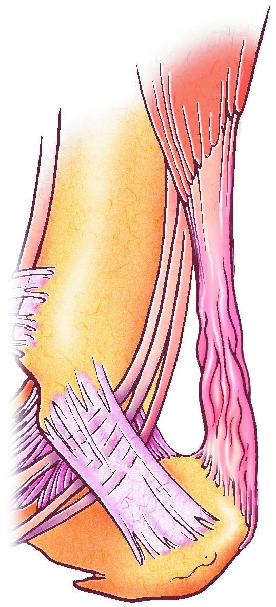 Medical illustration showing closeup of Achilles tendon and lateral ankle ligaments with torn tendon fibers highlighted in pink and purple — detailed anatomical drawing depicting tendon rupture and ligament injury
