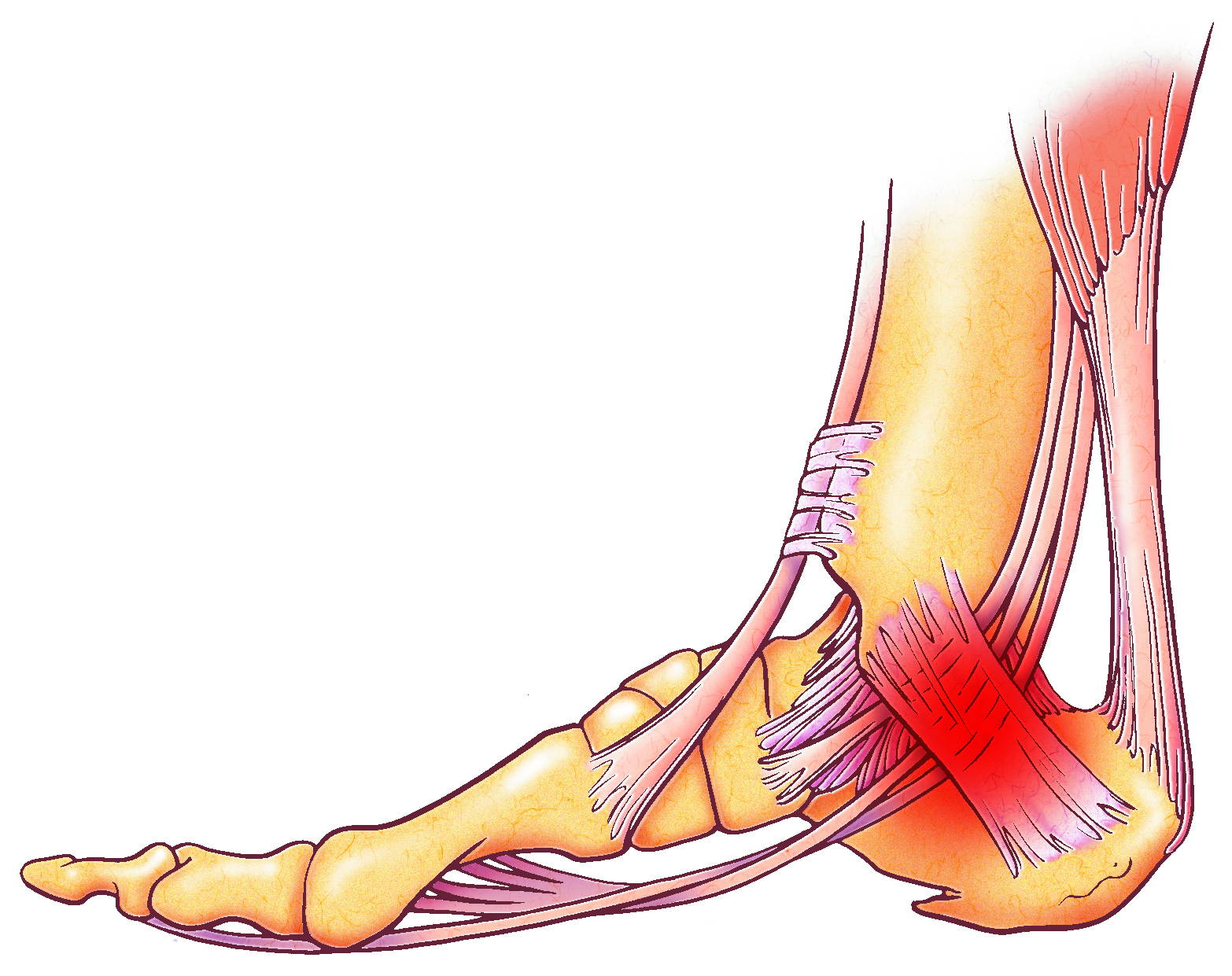 Illustrated anatomy of the ankle showing tendons, ligaments, and bones with red highlighted pain areas at the Achilles tendon and lateral ankle — side view diagram depicting ankle sprain and instability