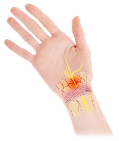 Medical illustration of carpal tunnel syndrome showing compressed median nerve at the wrist with red and orange highlighted pain area, radiating nerve pathways in yellow, and visible tendons — palm-side view depicting wrist nerve compression and pain