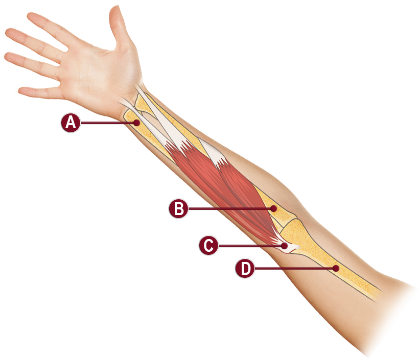 Medical illustration of forearm anatomy lateral view with transparent skin overlay showing labeled structures A through D including extensor muscle belly, lateral epicondyle attachment, and wrist tendon insertion

