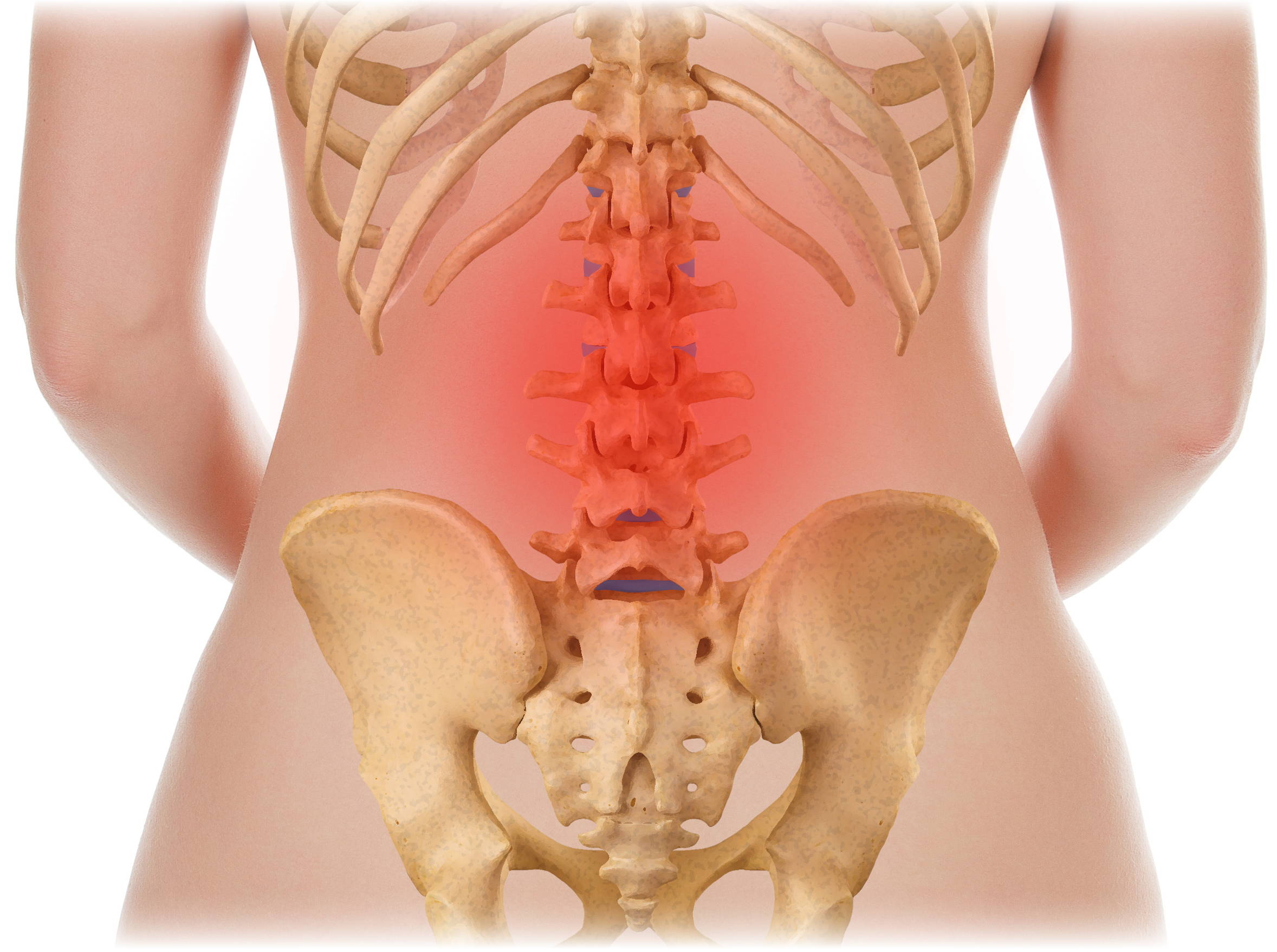 Medical illustration showing rear view of lumbar spine vertebrae highlighted in red indicating lower back pain and inflammation, with rib cage and pelvis anatomy visible
