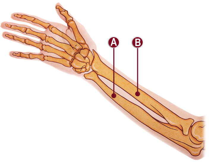 Medical illustration of forearm and wrist anatomy showing radius bone (A) and ulna bone (B) with carpal bones and hand skeleton with soft tissue overlay
